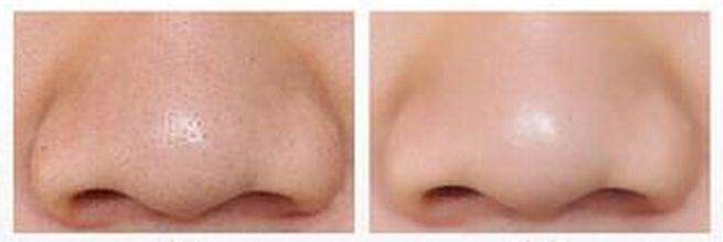 去黑頭的方法使用效果展示