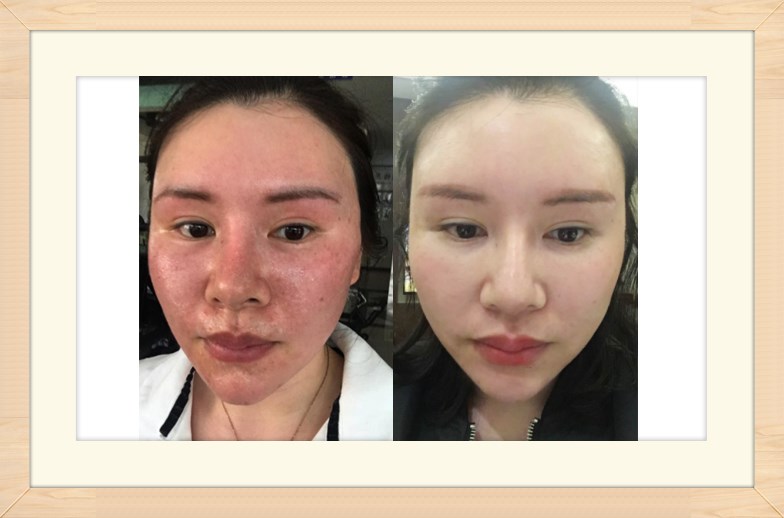 化妝品加工廠告訴你使用化妝品過敏了怎么辦？