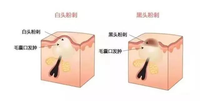 如何有效改善閉口粉刺？改善閉口粉刺的方法！